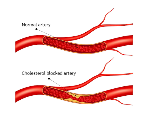 blocked artery